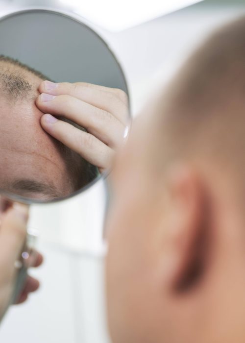 adult-male-having-balding-problems