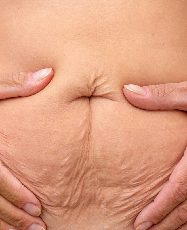 Cropped woman hands on belly pressed skin to show sagging skin after diet and stretch marks after pregnancy