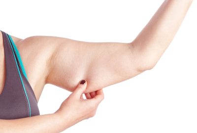 Middle-aged woman holding a hand with excess fat. On a white background.