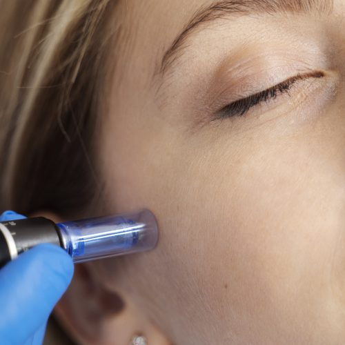 patient-undergoing-microneedling-procedure