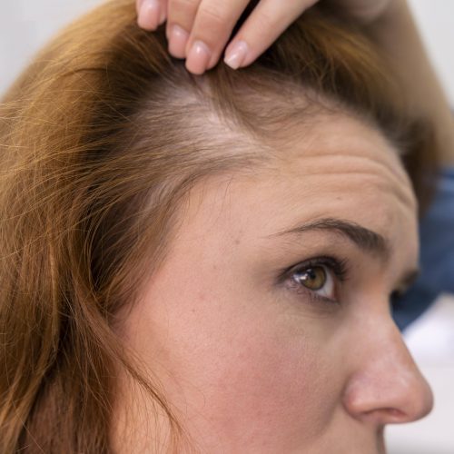 woman-getting-hair-loss-treatment-clinic